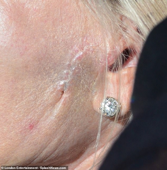 Fresh scar: While enjoying a solo drive through Los Angeles, the actress, 65, showed off a mark that appears to be healing, just above her ear on her flawless skin.